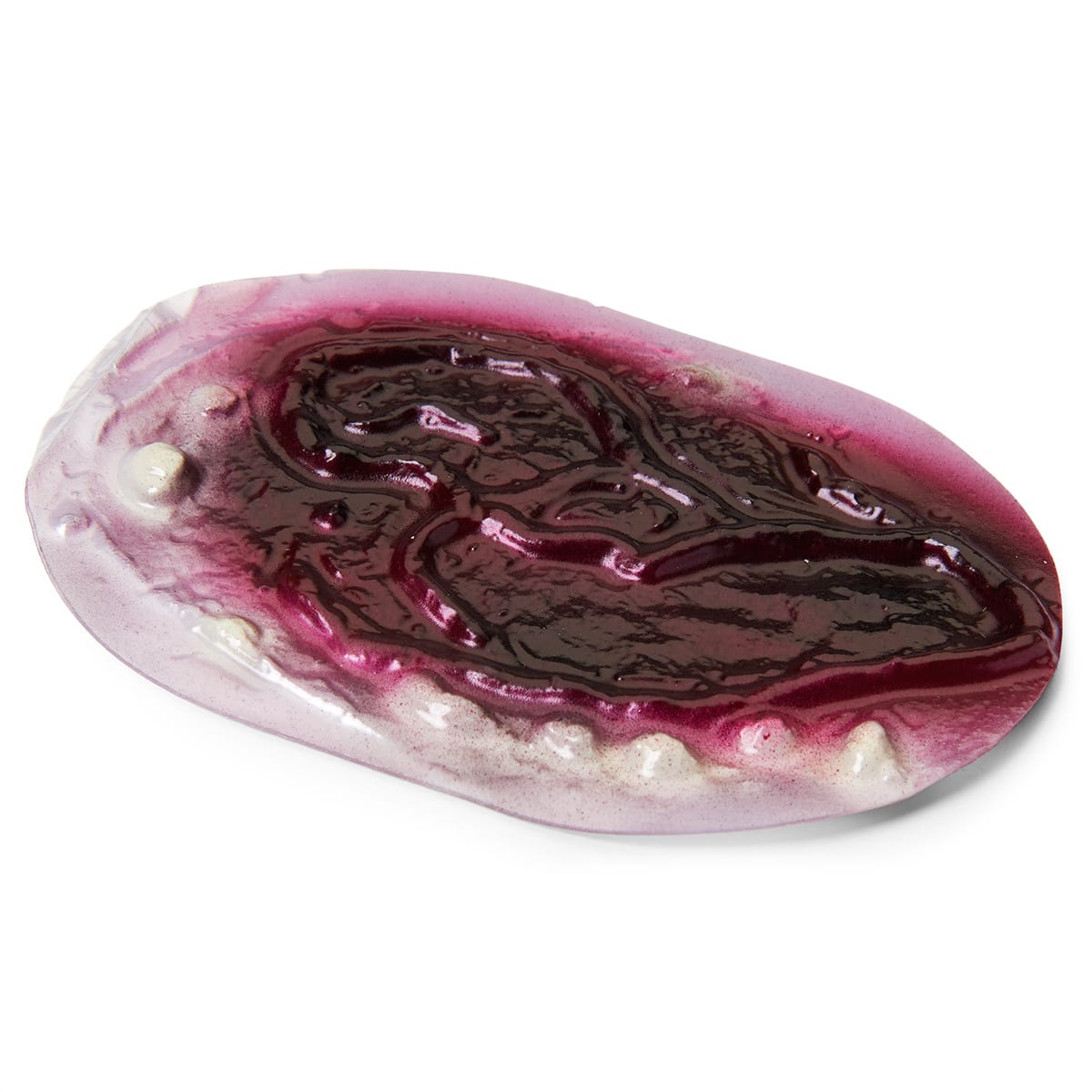 1st-2nd-and-3rd-degree-burn-1386