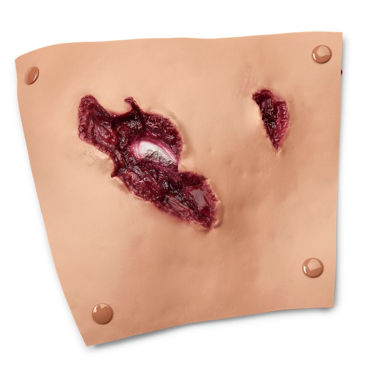 compound-fracture-femur-3081-p